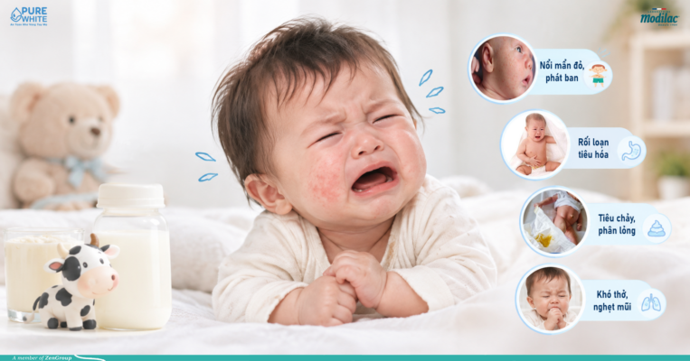 Trẻ quấy khóc do dấu hiệu dị ứng đạm sữa bò